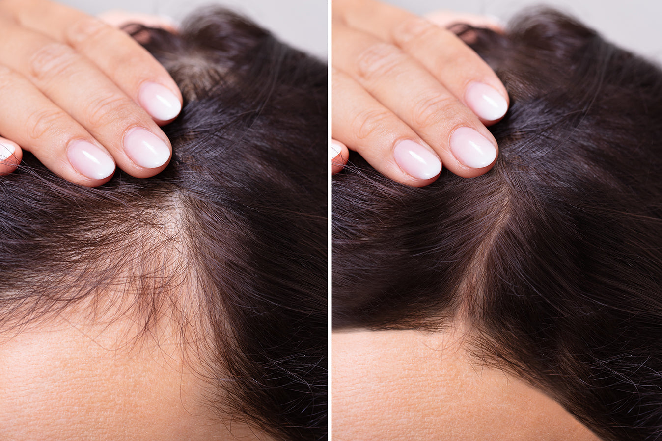 Caduta dei capelli: le cause più comuni da conoscere